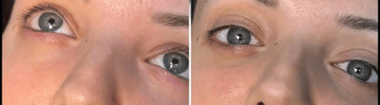 Dermal Fillers