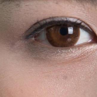 Eye Bag  Removal