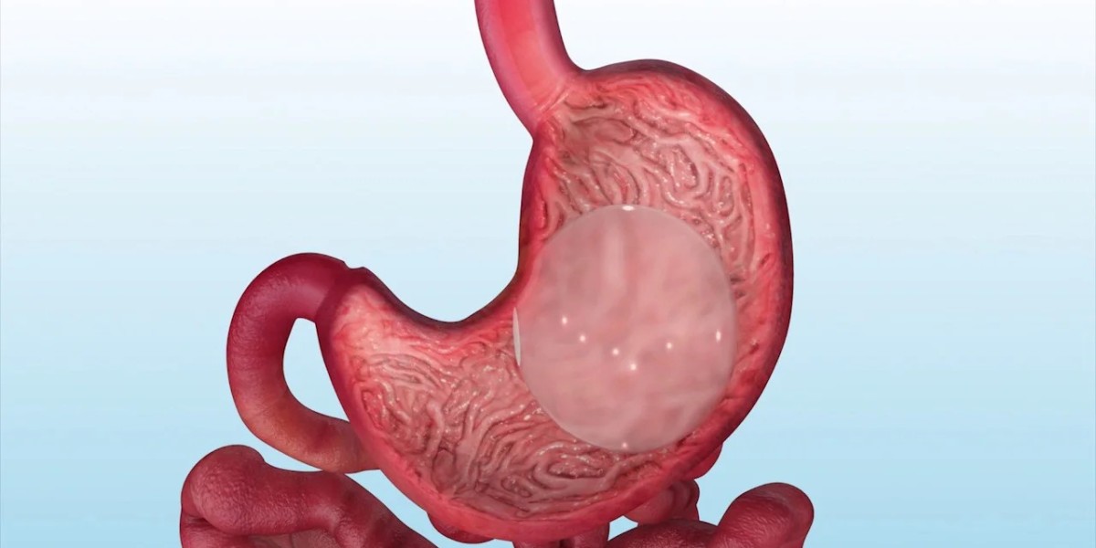 What Are the Success Rates of Gastric Balloon Placement?