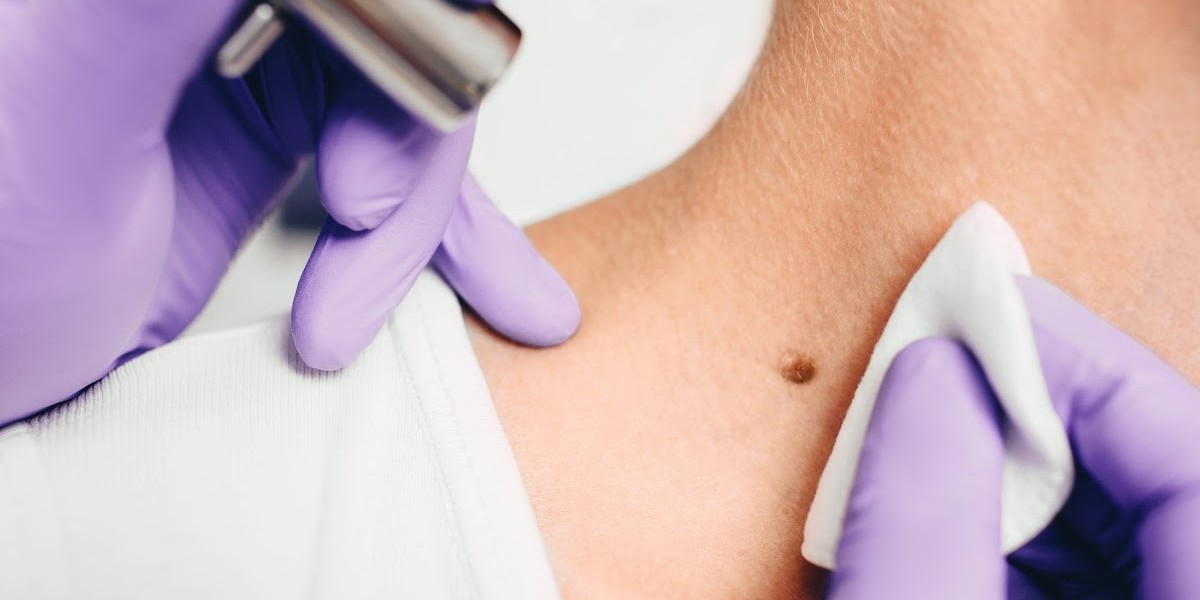 Skin Tag Removal: Signs It’s Time to Consider Treatment