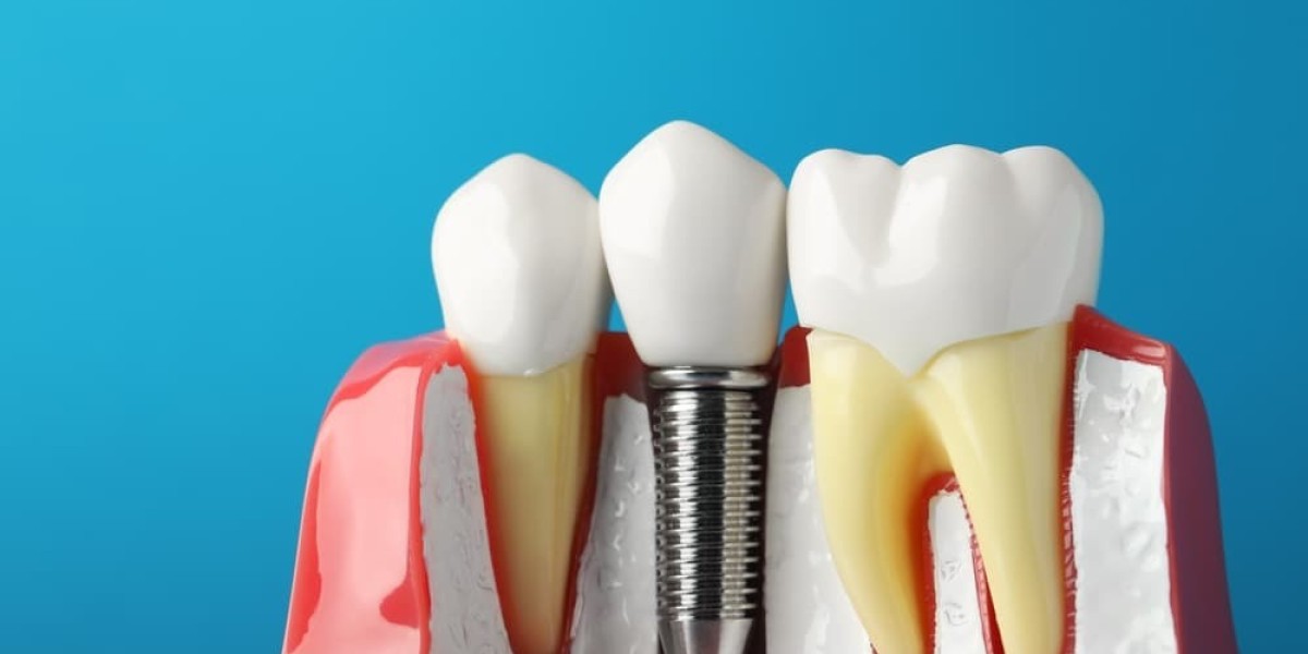 Your Perfect Smile Starts with Single Tooth Implant Cost Planning