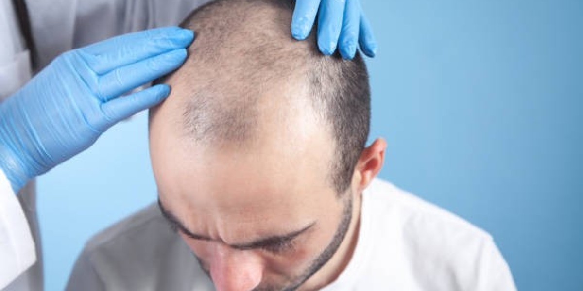 هل تصلح زراعة الشعر للنساء كما تصلح للرجال؟