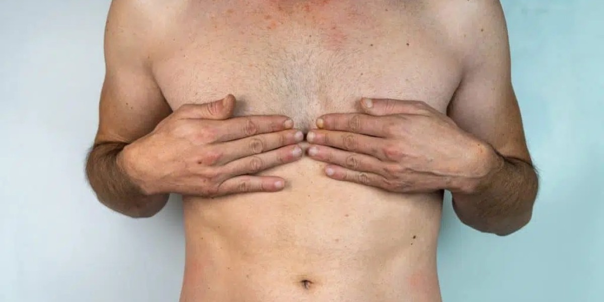 Gynecomastia Symptoms in Men: A Detailed Guide