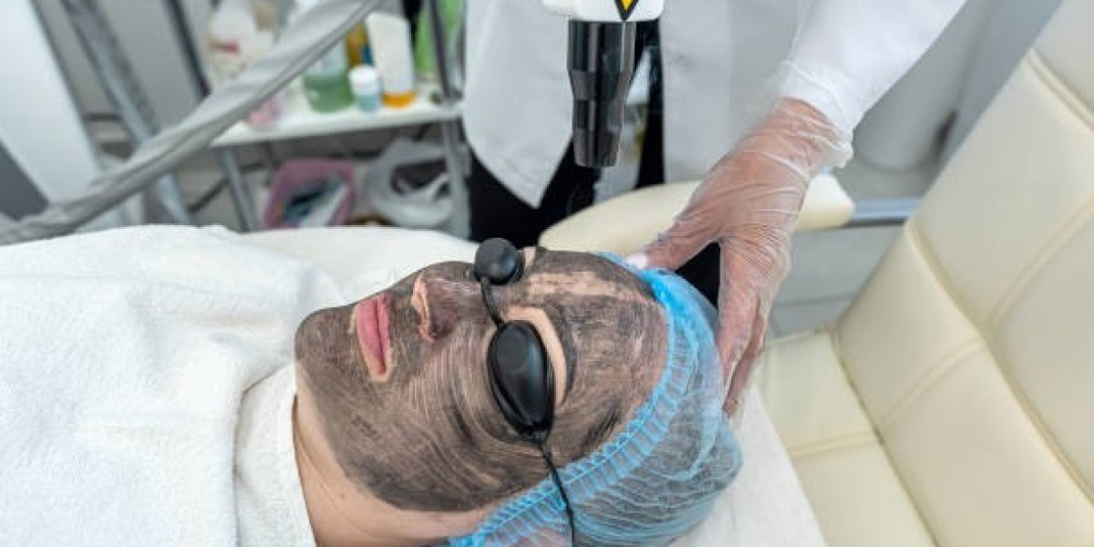 Laser Carbon Peel Treatment for Youthful Looking Skin