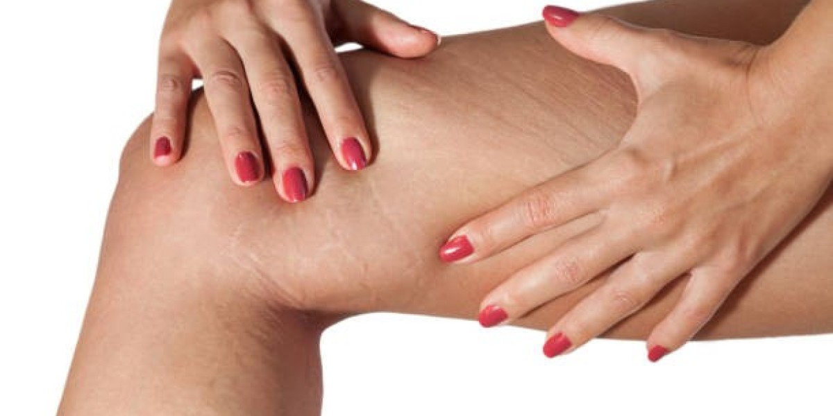 Stretch Mark Removal Methods That Support Skin Healing