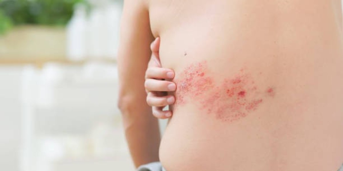 كيف يؤثر الحزام الناري: الأعراض والأسباب وطرق العلاج على الأعصاب وما هو ألم الاعتلال العصبي؟