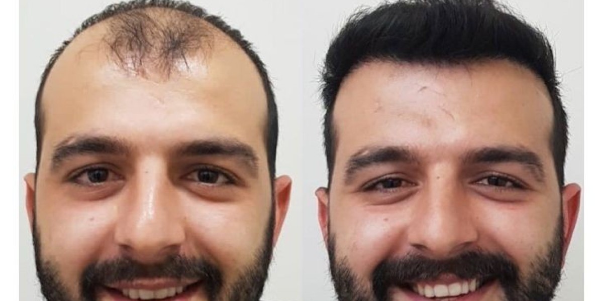 Hair Transplant in Islamabad: Benefits Over Other Hair Loss Treatments