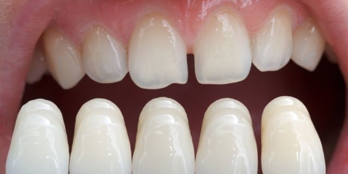 Composite Veneers That Create Smiles Full of Charm and Beauty