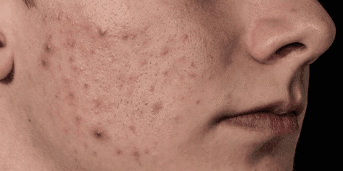 What Are the Key Approaches in Acne Treatment?