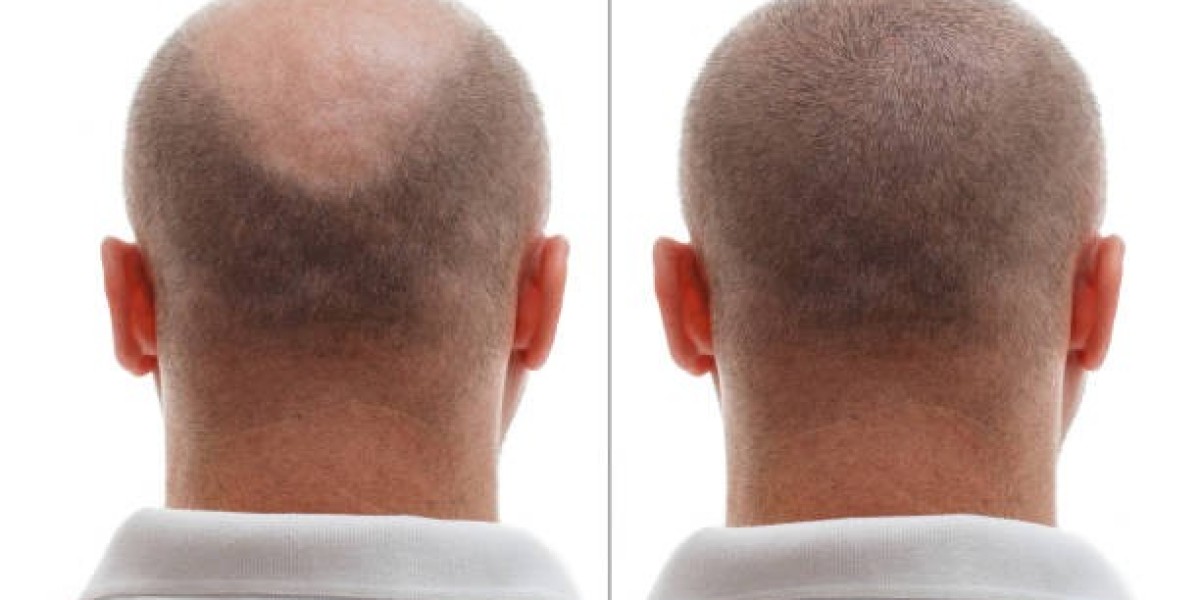 Stem Cell Hair Transplant Emerging in Riyadh Clinics