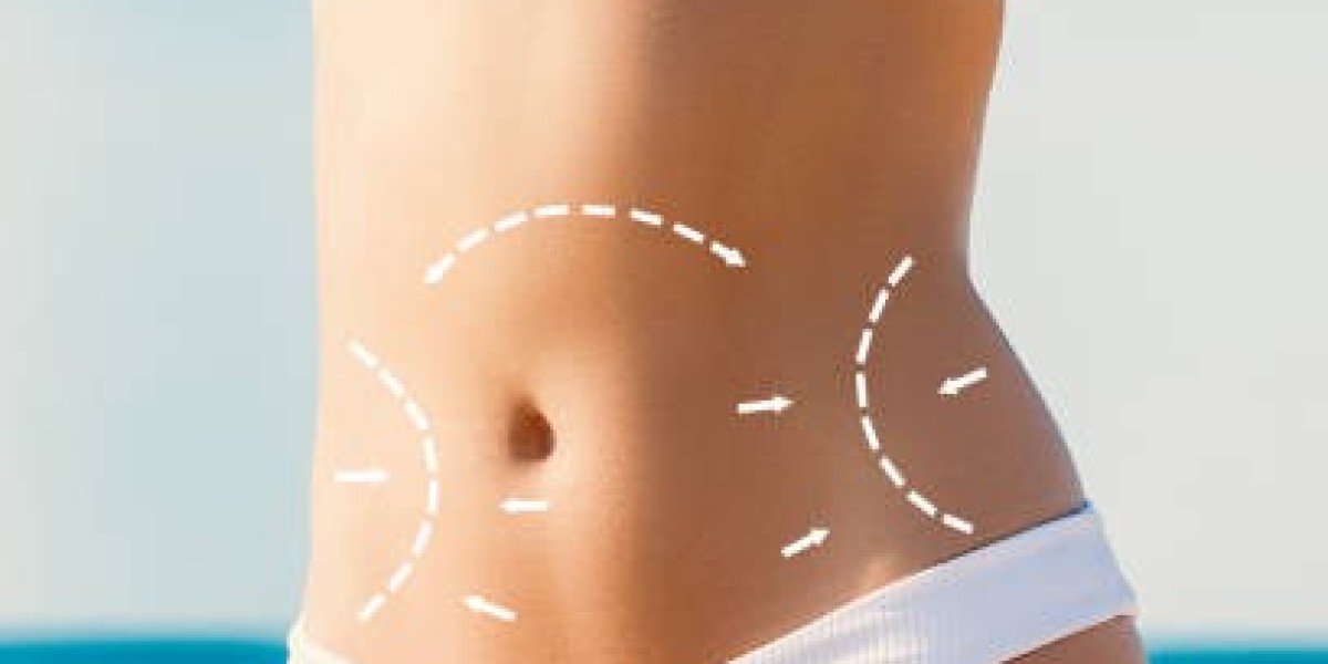 Laser Liposuction Benefits for Precision Body Shaping