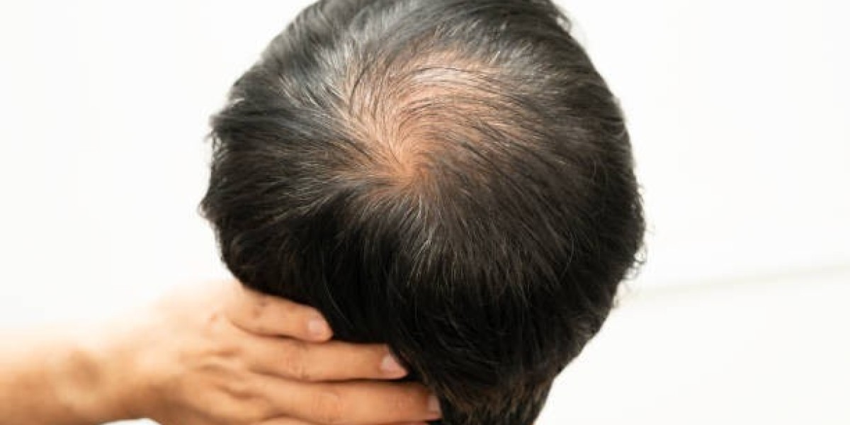 Exosomes Therapy for Hair Loss and Hair Density Boost