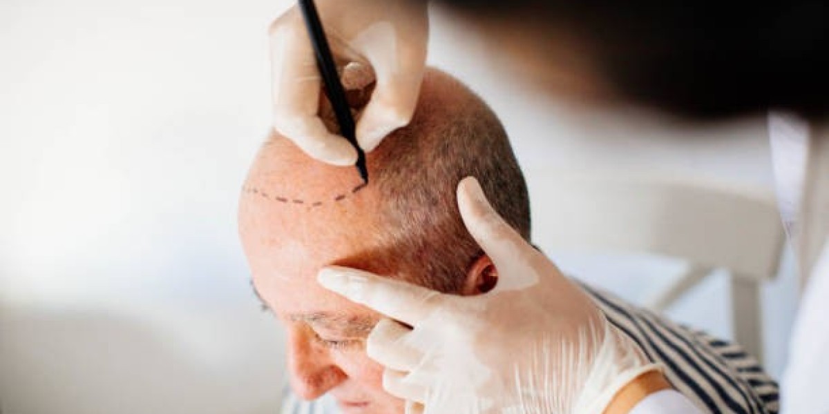 Hair Transplantation Techniques for Natural Looking Hair