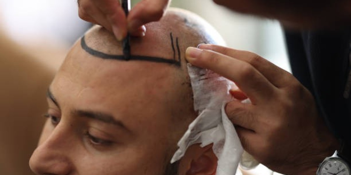 Nutrition Boosts Post-Hair Transplant in Riyadh Diets