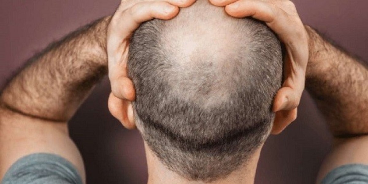 Dubai Crown Hair Transplant Natural Look Tips