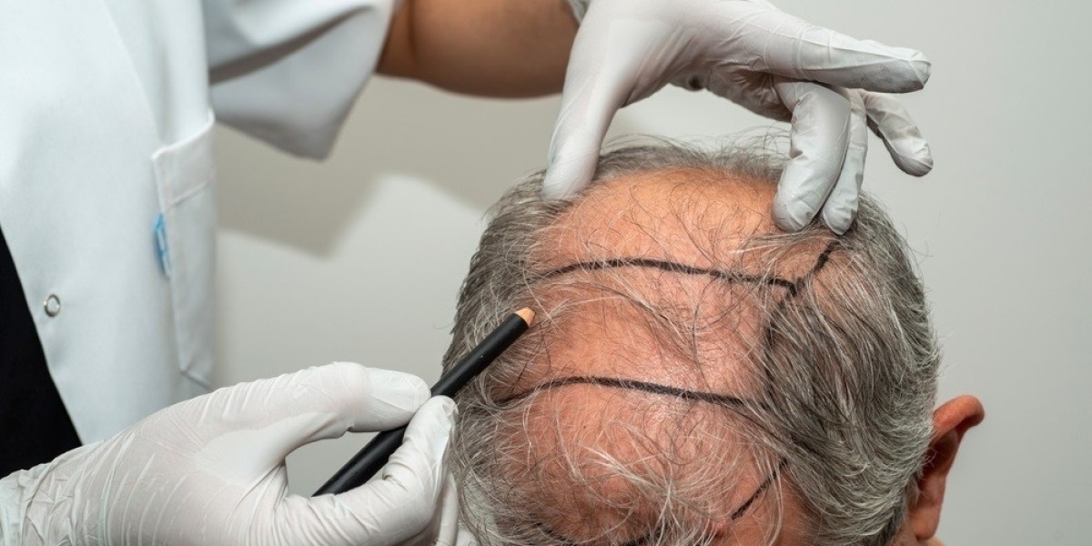 Understanding Hair Restoration Value Over Time