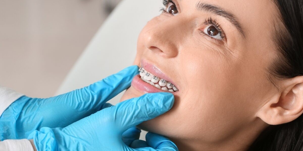 What Patients Ask About Braces Cost in Dubai