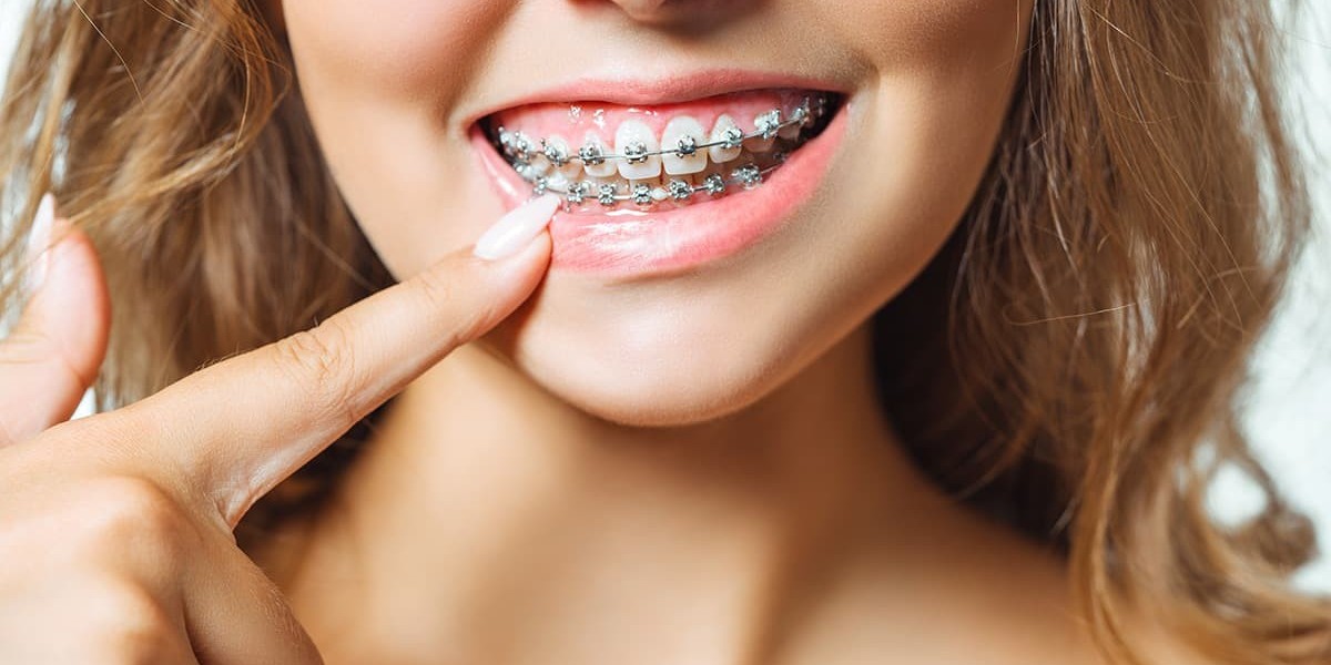Things to Know About Teeth Braces Cost