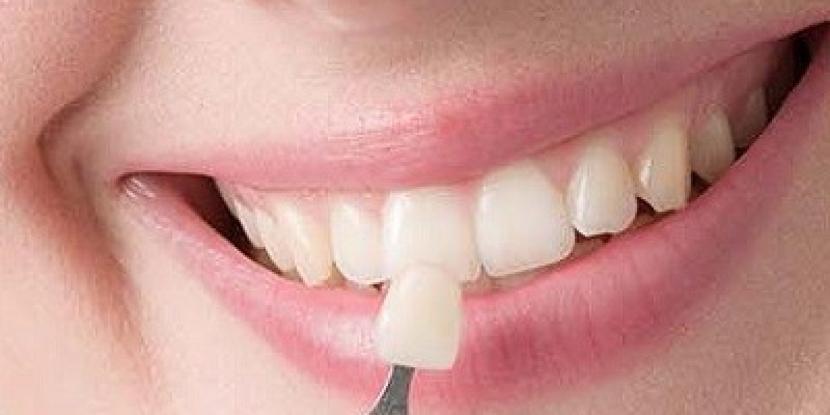 Transform Your Smile Instantly With Composite Veneers Magic