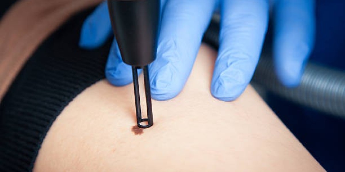 Prevent Warts Recurrence After Riyadh Removal Therapy