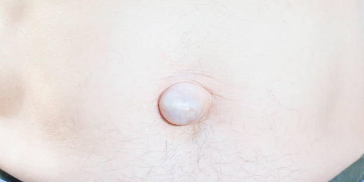 Hernia Surgery Preparation Checklist for Patients