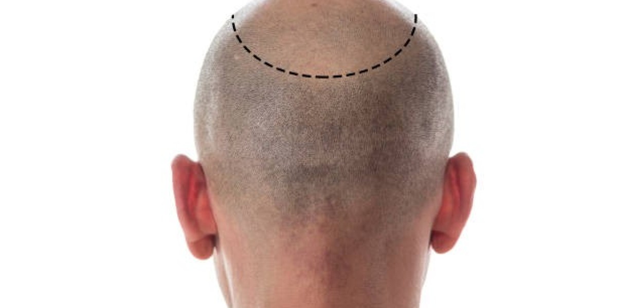 Dermaroller Routine After Hair Transplant Riyadh