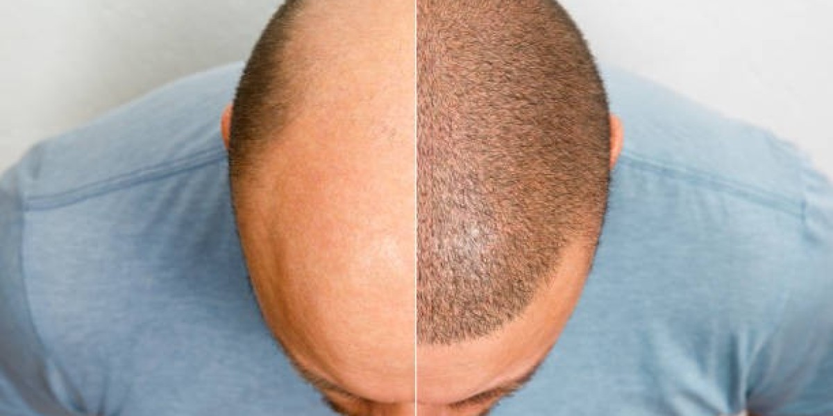Hair Transplant Impact on Appearance and Confidence