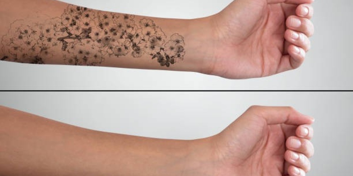 Laser Tattoo Removal for Old and New Tattoo Ink