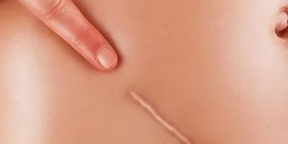 Who Is an Ideal Candidate for Scar Removal Dubai?