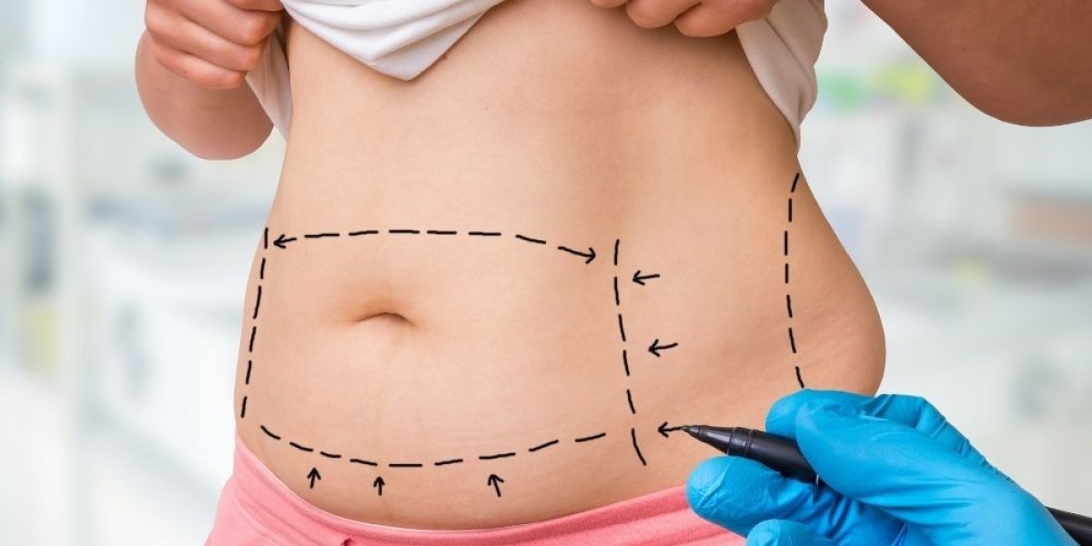 Say Goodbye to Loose Skin with Lipo Abdominoplasty