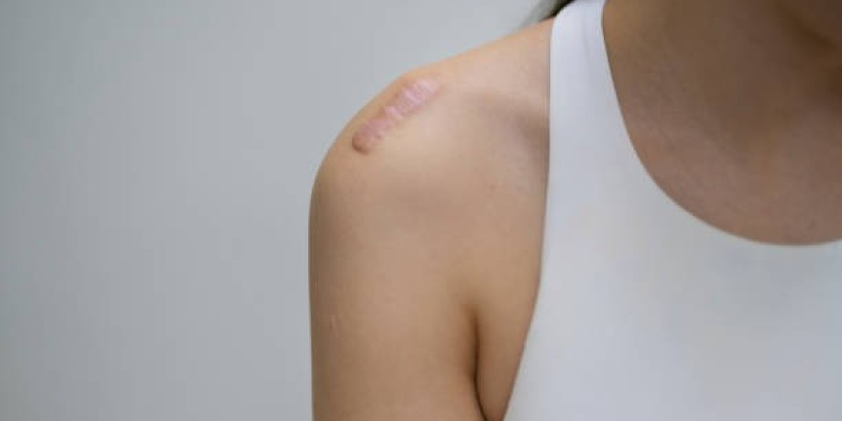 Laser Scar Removal for Natural Skin Healing and Renewal