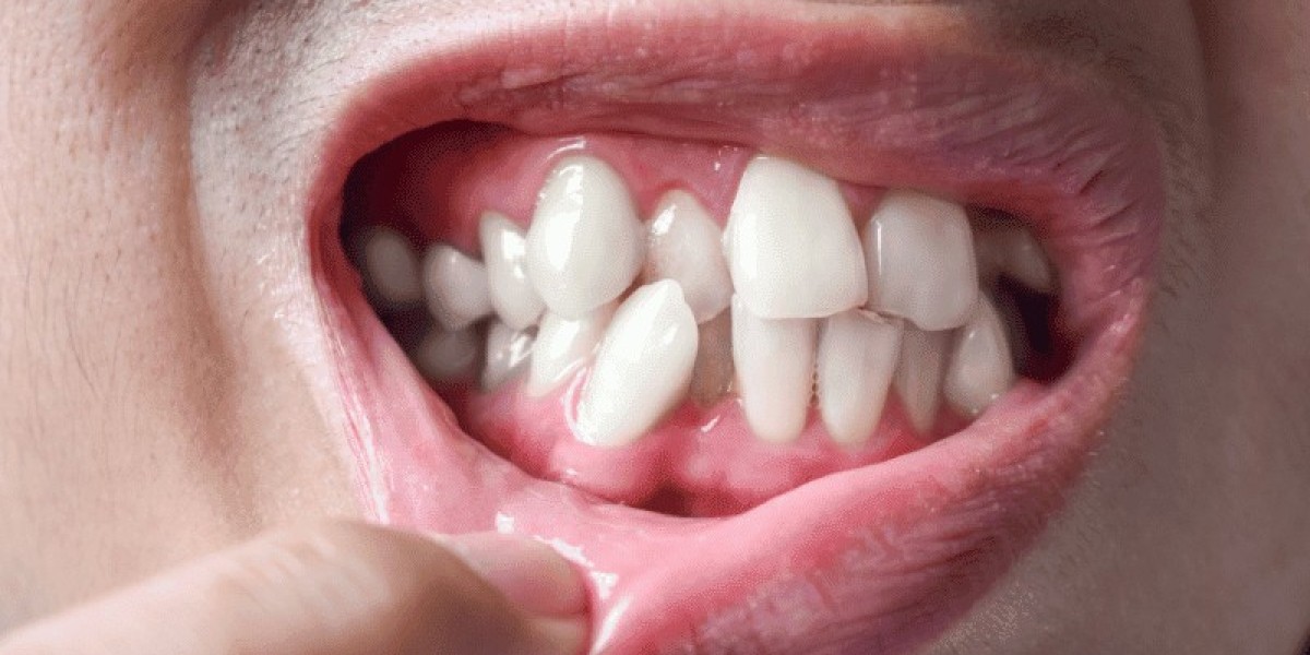 Crooked Teeth Treatment: Braces vs. Clear Aligners