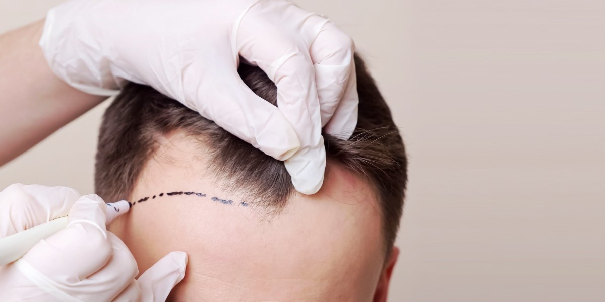 Can Hair Transplant in Dubai Achieve Full, Youthful Hair Elegantly?