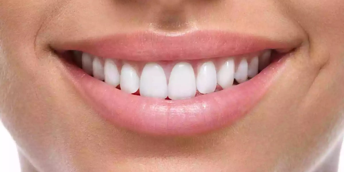 Transform Your Look Instantly With Composite Veneers in Dubai