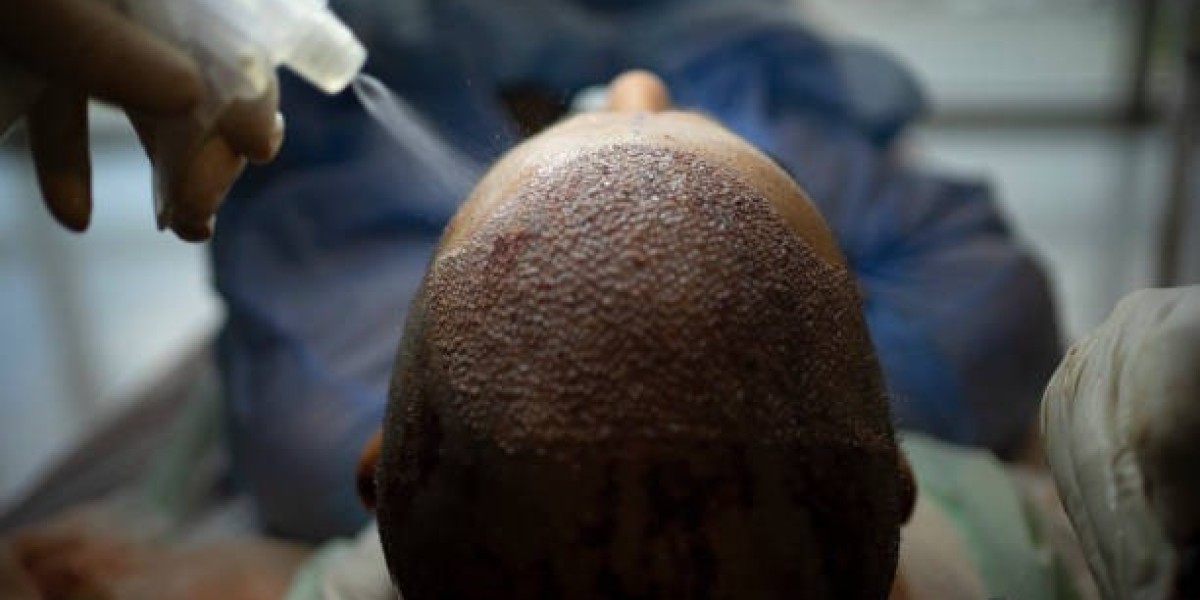 Hair Transplant Options for Progressive Hair Thinning