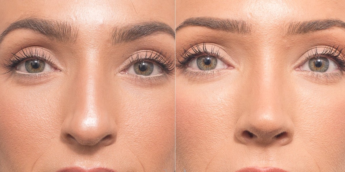 Reveal Harmonious Symmetry Naturally through Rhinoplasty