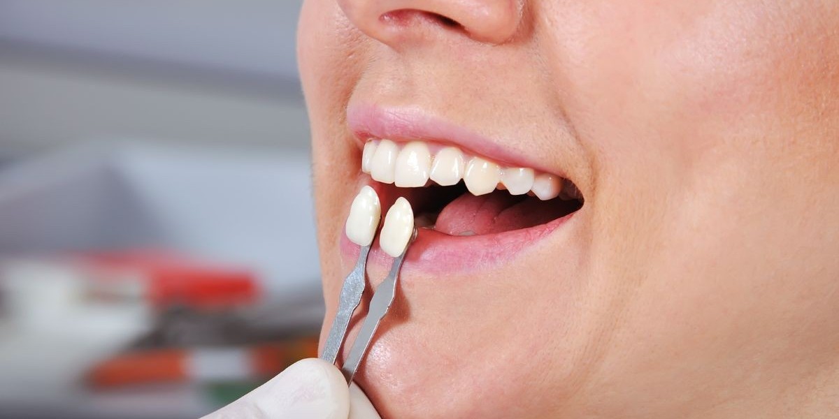 Can a Dental Tooth Filling Fall Out? Causes and Solutions