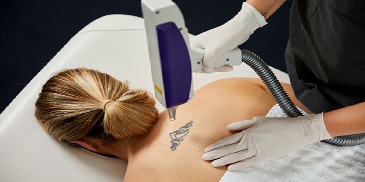 Laser Tattoo Removal for Fast, Gentle, and Visible Skin Renewal That Lasts